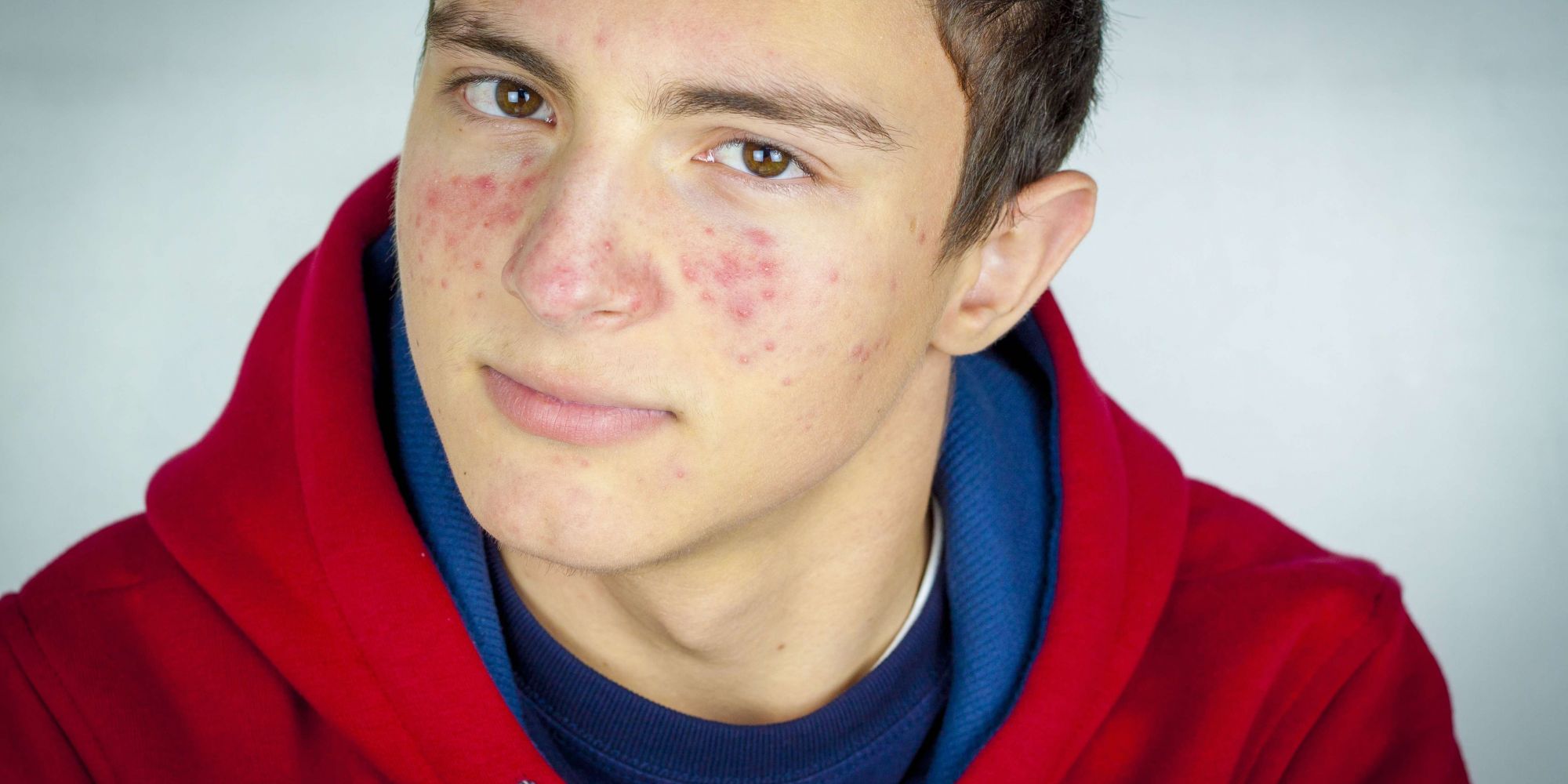 Is The Skin-Positivity Movement Putting Acne Solution Brands In A Spotty Situation?